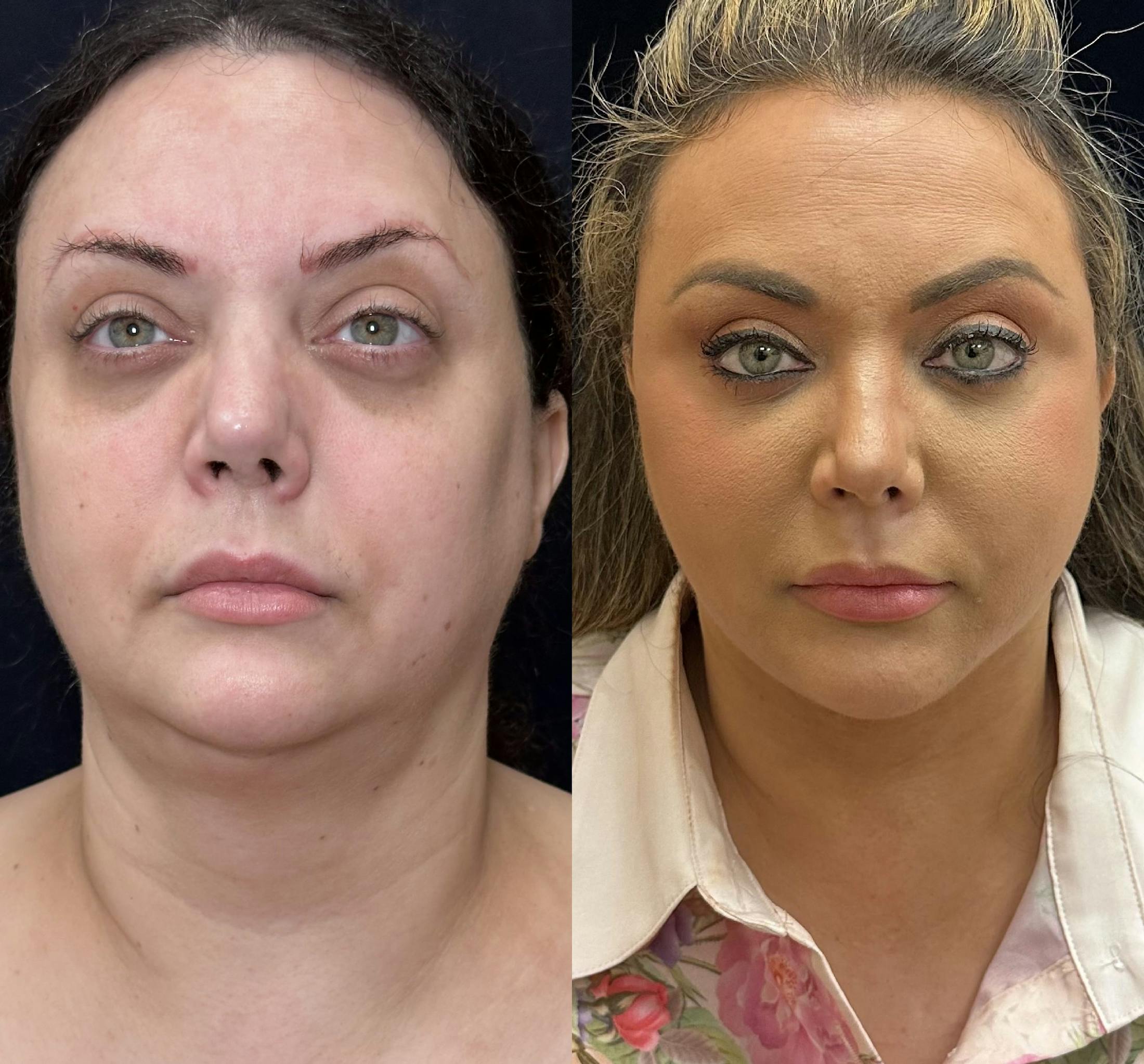 Deep Plane Facelift Before & After Gallery - Patient 108805 - Image 5