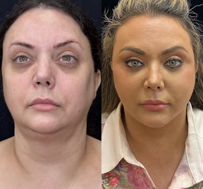 Deep Plane Facelift Before & After Gallery - Patient 108805 - Image 5