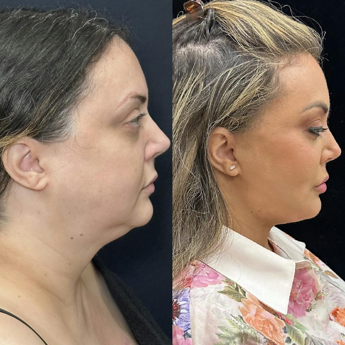 Buccal Fat Reduction Before & After Gallery - Patient 483424 - Image 1