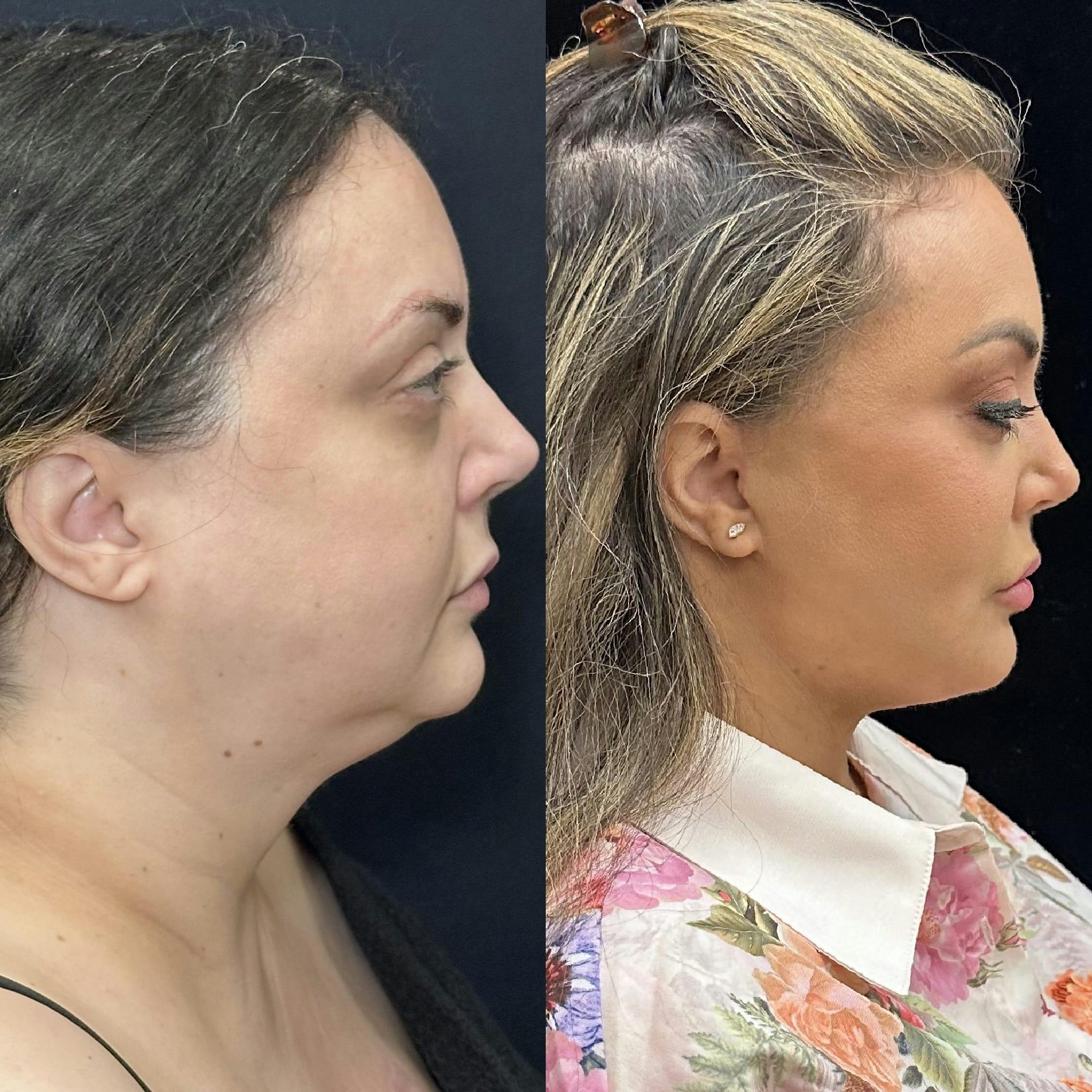 Deep Plane Facelift Before & After Gallery - Patient 108805 - Image 1