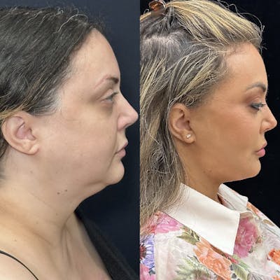 Deep Plane Facelift Before & After Gallery - Patient 108805 - Image 1