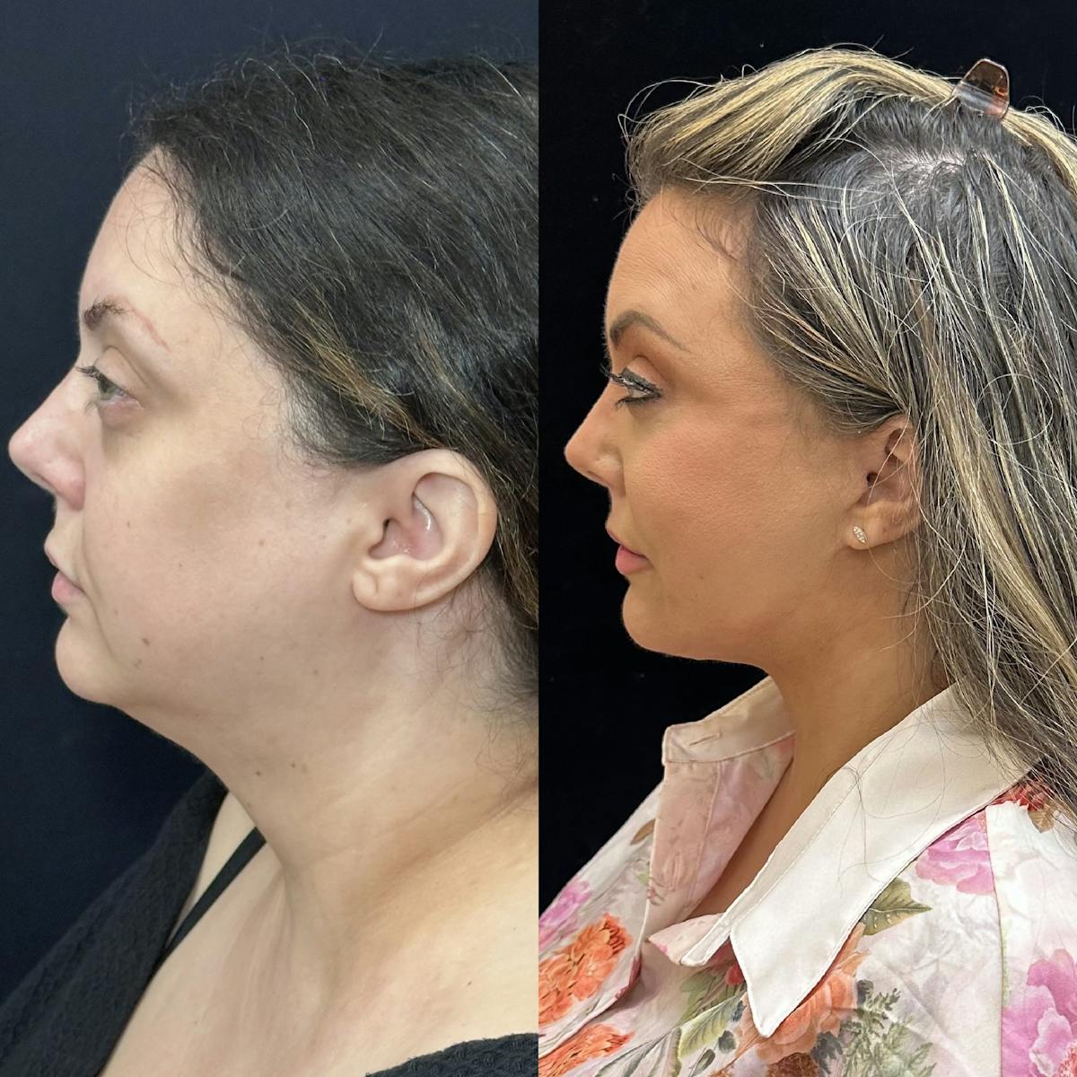 Buccal Fat Reduction Before & After Gallery - Patient 483424 - Image 2