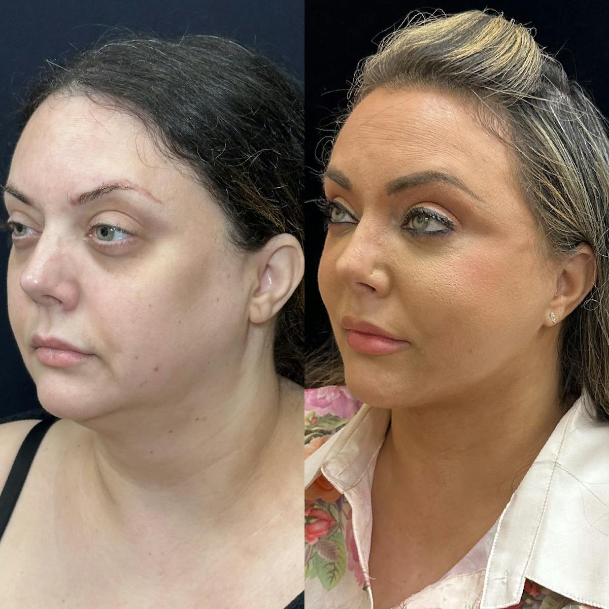 Buccal Fat Reduction Before & After Gallery - Patient 483424 - Image 4