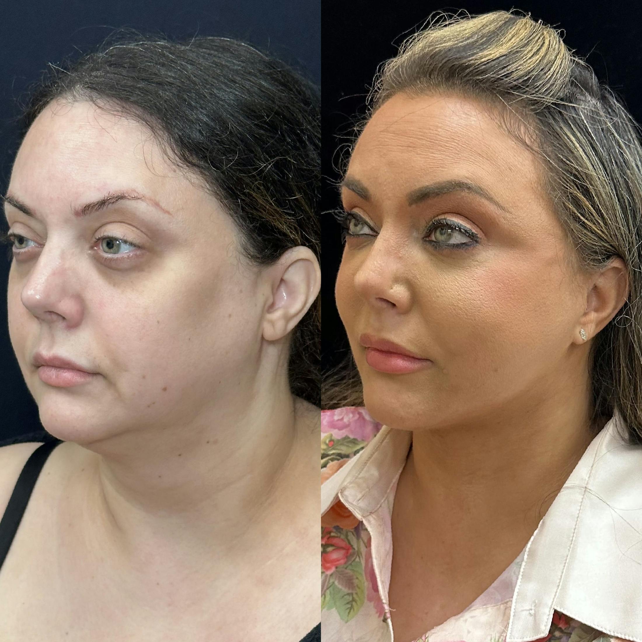 Deep Plane Facelift Before & After Gallery - Patient 108805 - Image 4