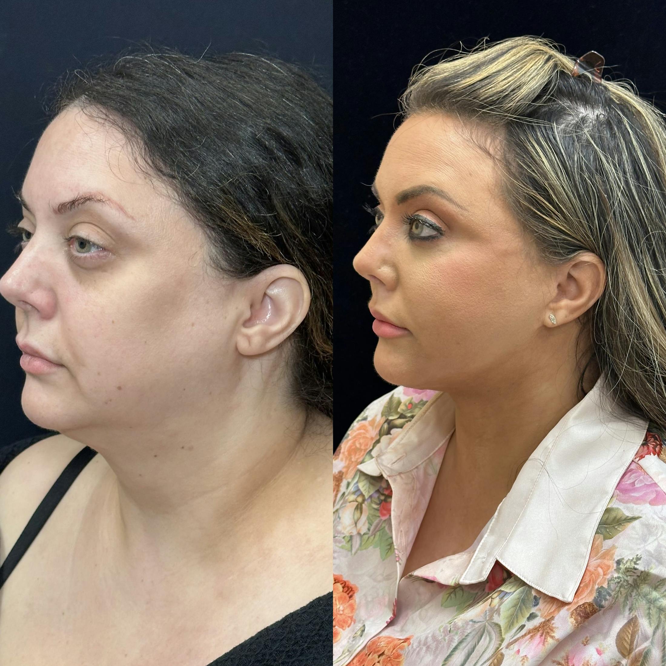 Deep Plane Facelift Before & After Gallery - Patient 108805 - Image 7