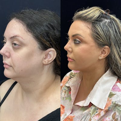 Deep Plane Facelift Before & After Gallery - Patient 108805 - Image 7