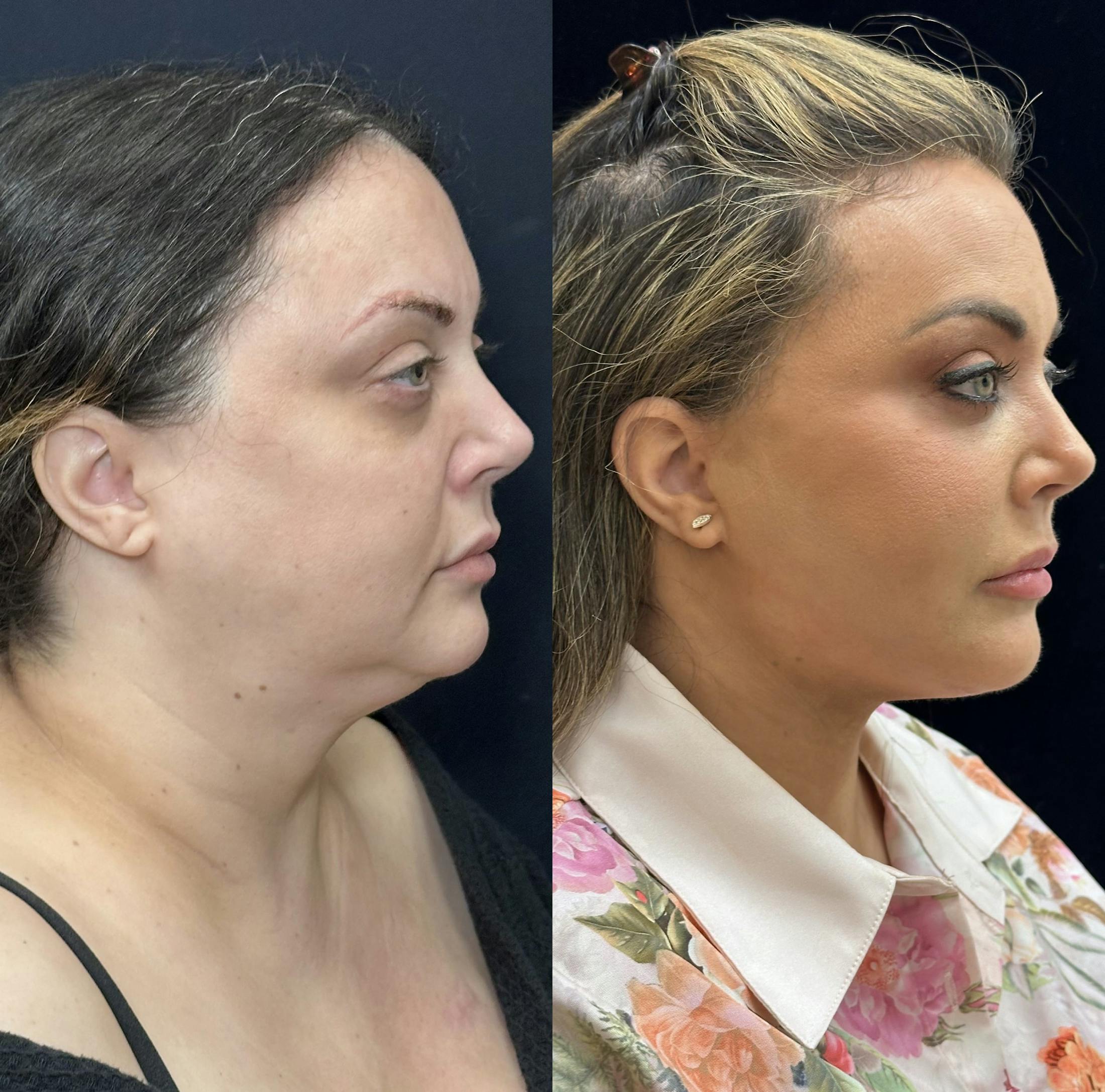 Deep Plane Facelift Before & After Gallery - Patient 108805 - Image 3