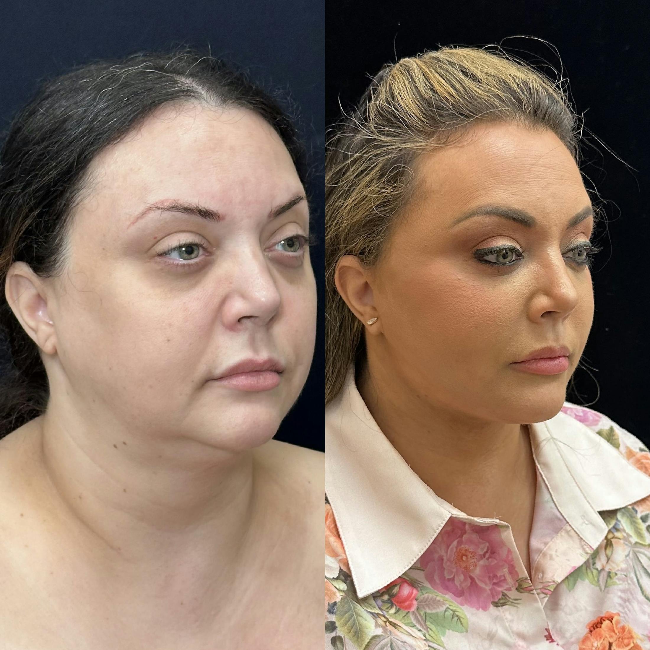 Deep Plane Facelift Before & After Gallery - Patient 108805 - Image 6