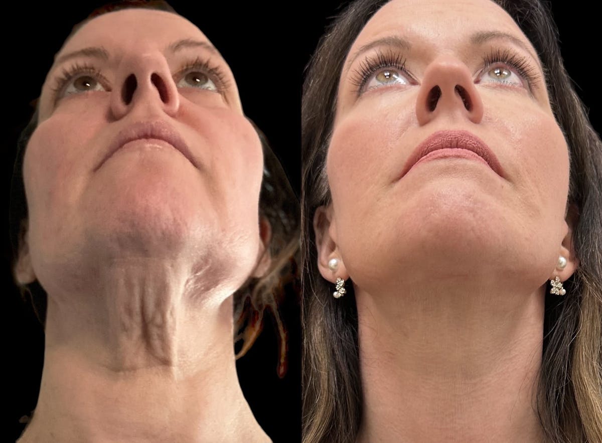  Facial Fat Transfer Before & After Gallery - Patient 373119 - Image 1