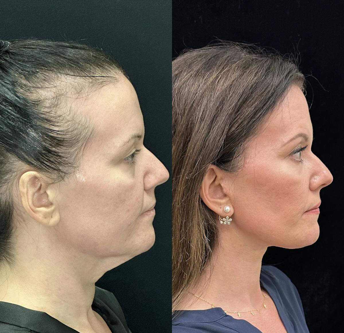  Facial Fat Transfer Before & After Gallery - Patient 373119 - Image 4