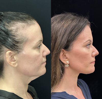 Deep Plane Facelift Before & After Gallery - Patient 248025 - Image 5