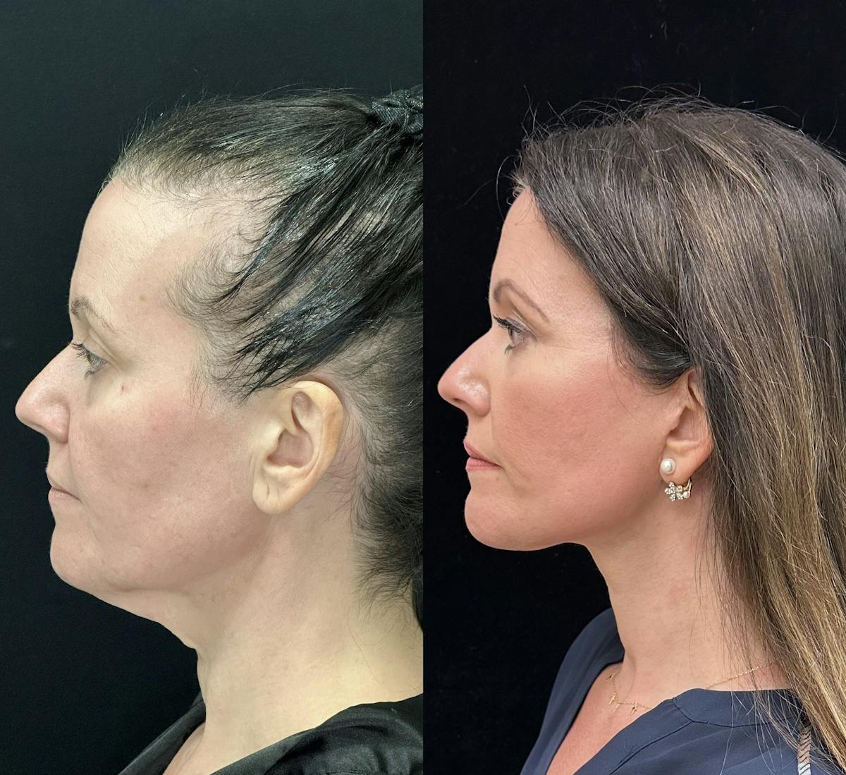  Facial Fat Transfer Before & After Gallery - Patient 373119 - Image 3