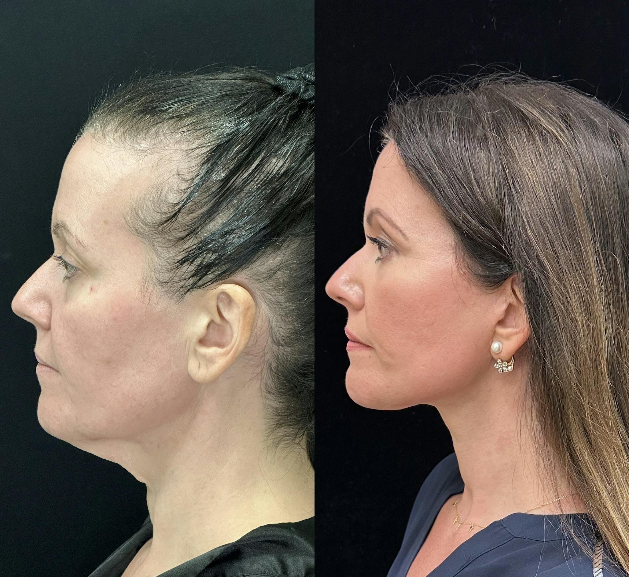 Necklift Before & After Gallery - Patient 192952 - Image 3