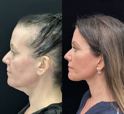 Deep Plane Facelift Before & After Gallery - Patient 248025 - Image 4