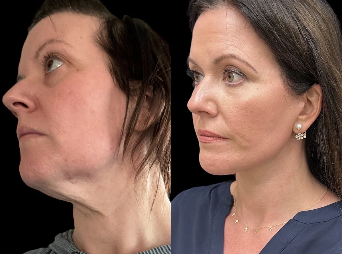  Facial Fat Transfer Before & After Gallery - Patient 373119 - Image 2