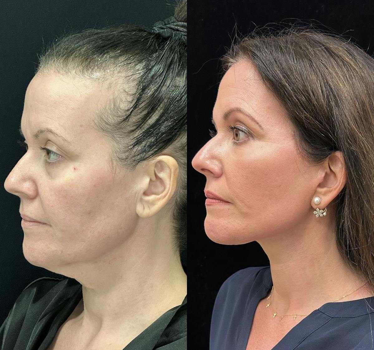  Facial Fat Transfer Before & After Gallery - Patient 373119 - Image 6
