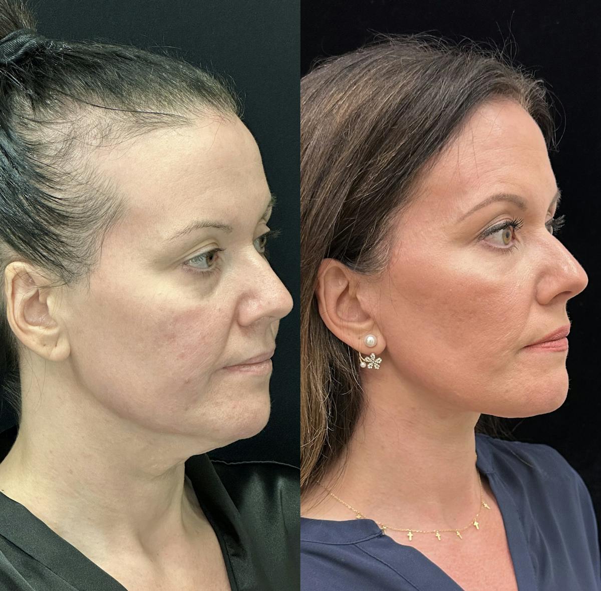  Facial Fat Transfer Before & After Gallery - Patient 373119 - Image 5