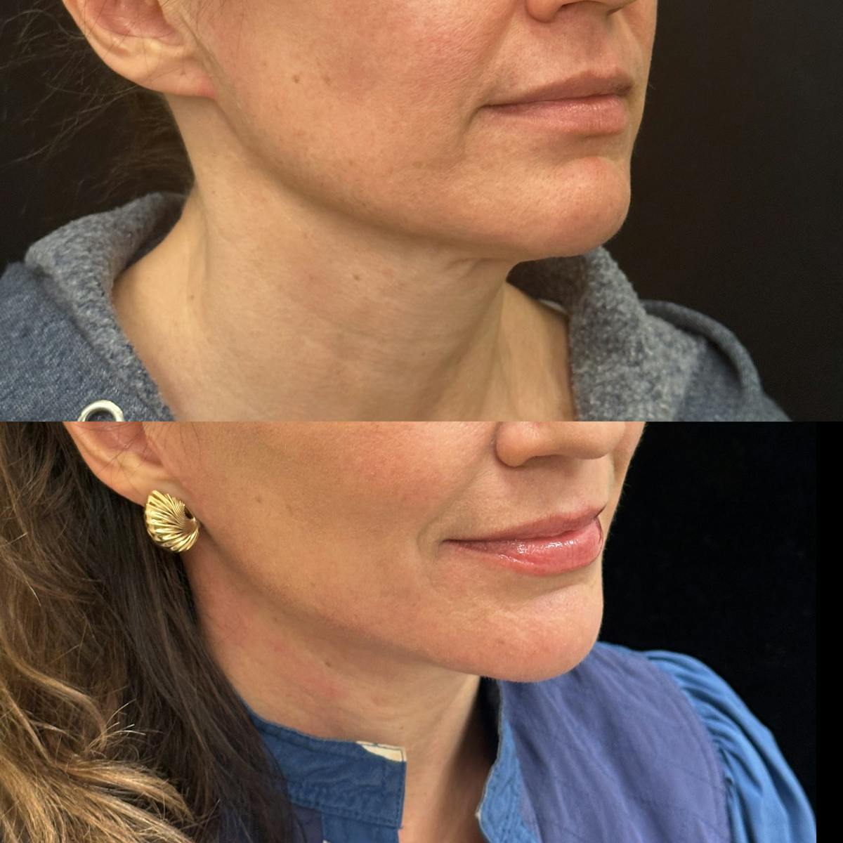 Necklift Before & After Gallery - Patient 167110 - Image 3