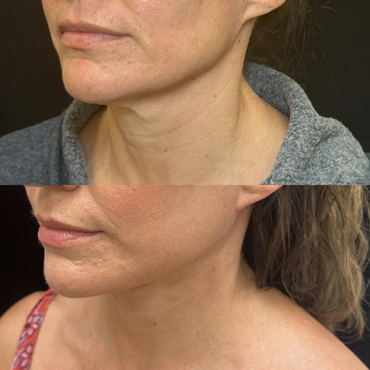 Necklift Before & After Gallery - Patient 167110 - Image 2