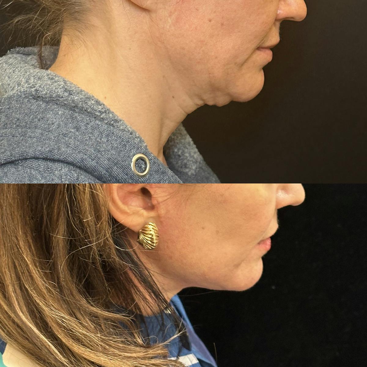 Necklift Before & After Gallery - Patient 167110 - Image 1