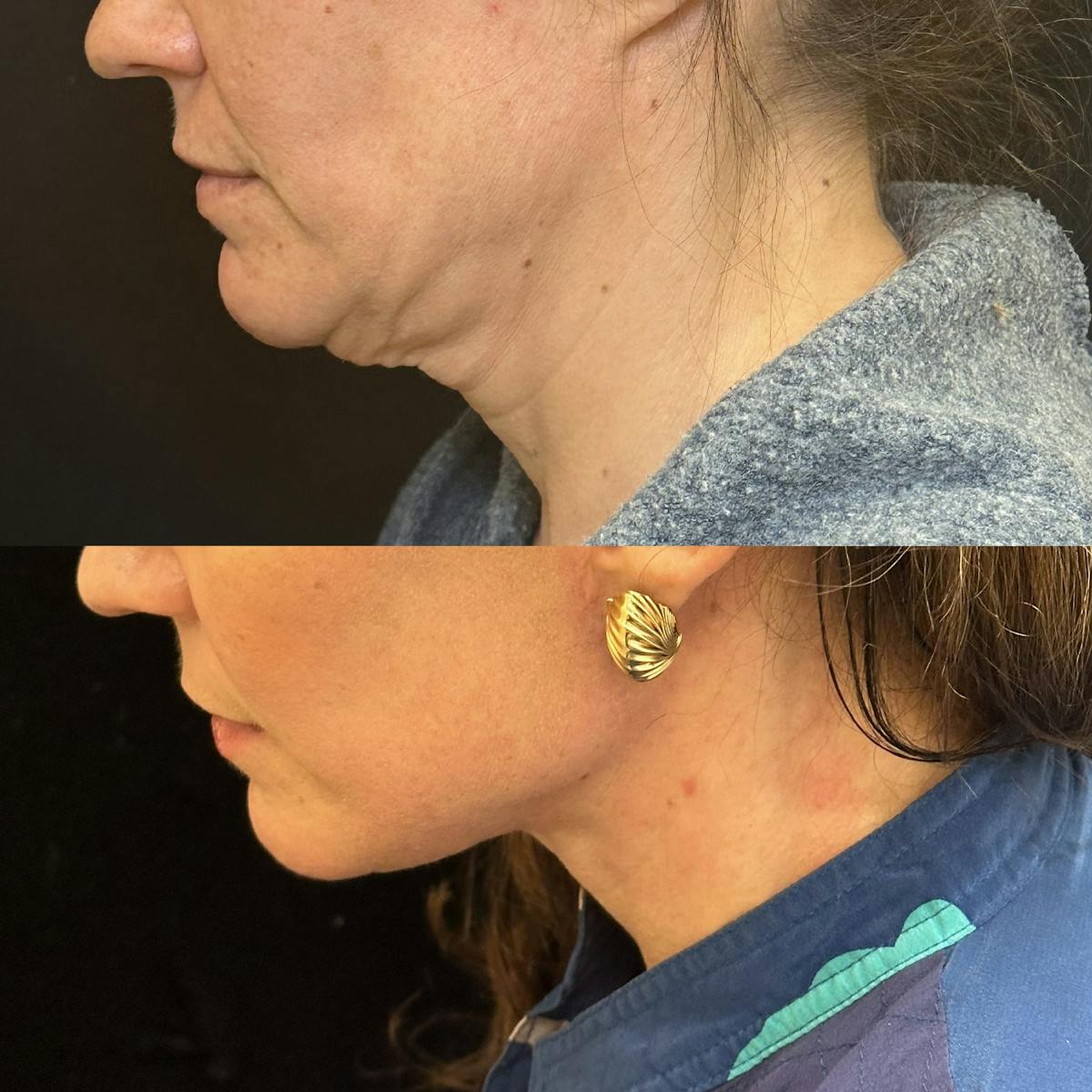Necklift Before & After Gallery - Patient 167110 - Image 4