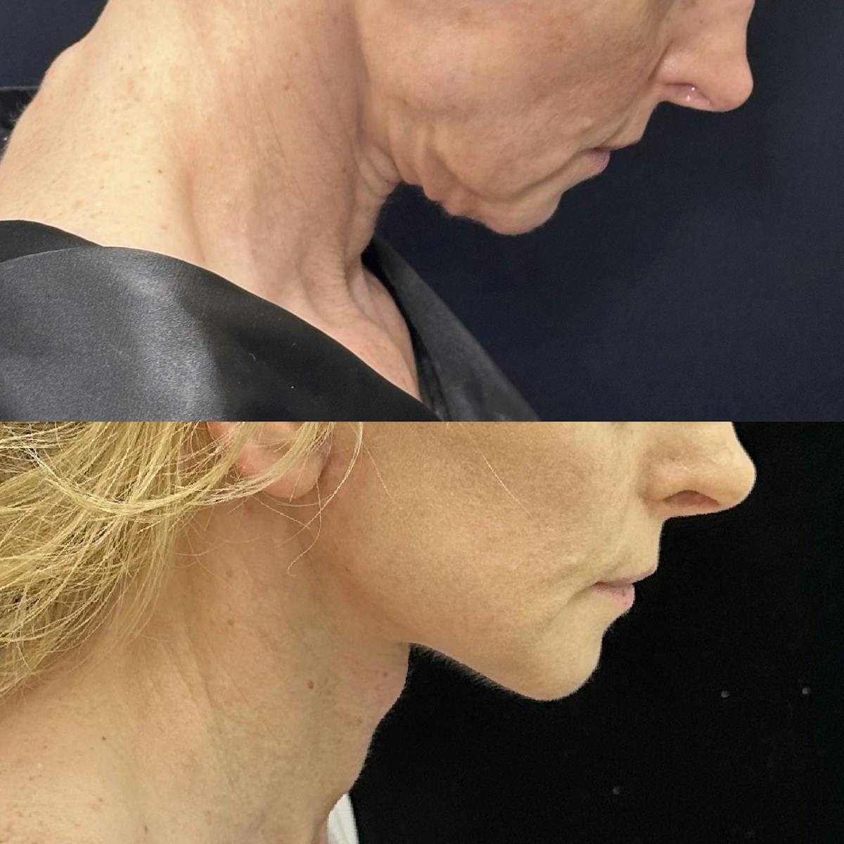 Deep Plane Facelift Before & After Gallery - Patient 635760 - Image 3