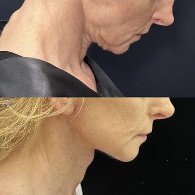 Deep Plane Facelift Before & After Gallery - Patient 635760 - Image 3