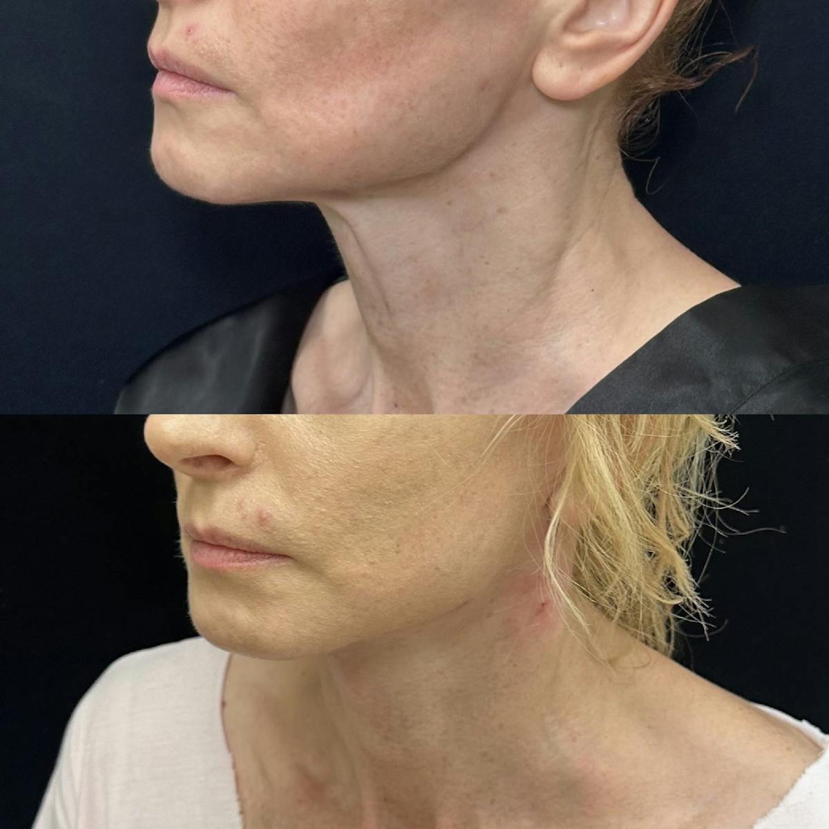 Deep Plane Facelift Before & After Gallery - Patient 635760 - Image 1