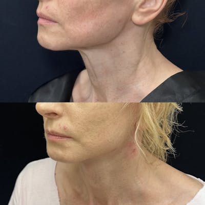 Deep Plane Facelift Before & After Gallery - Patient 635760 - Image 1