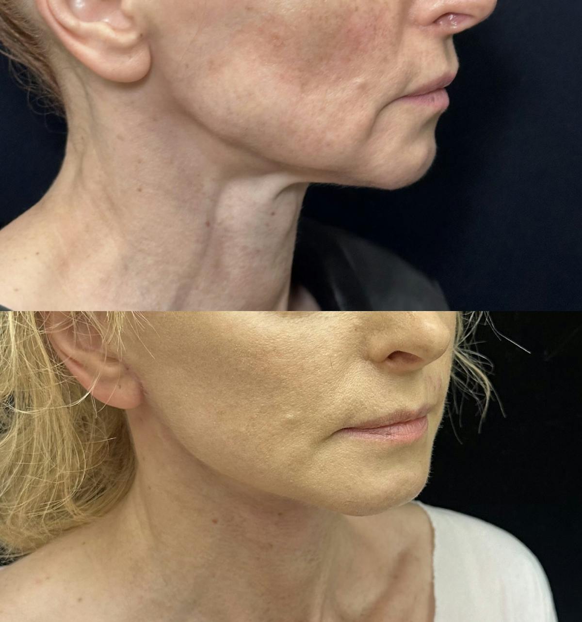 Deep Plane Facelift Before & After Gallery - Patient 635760 - Image 2