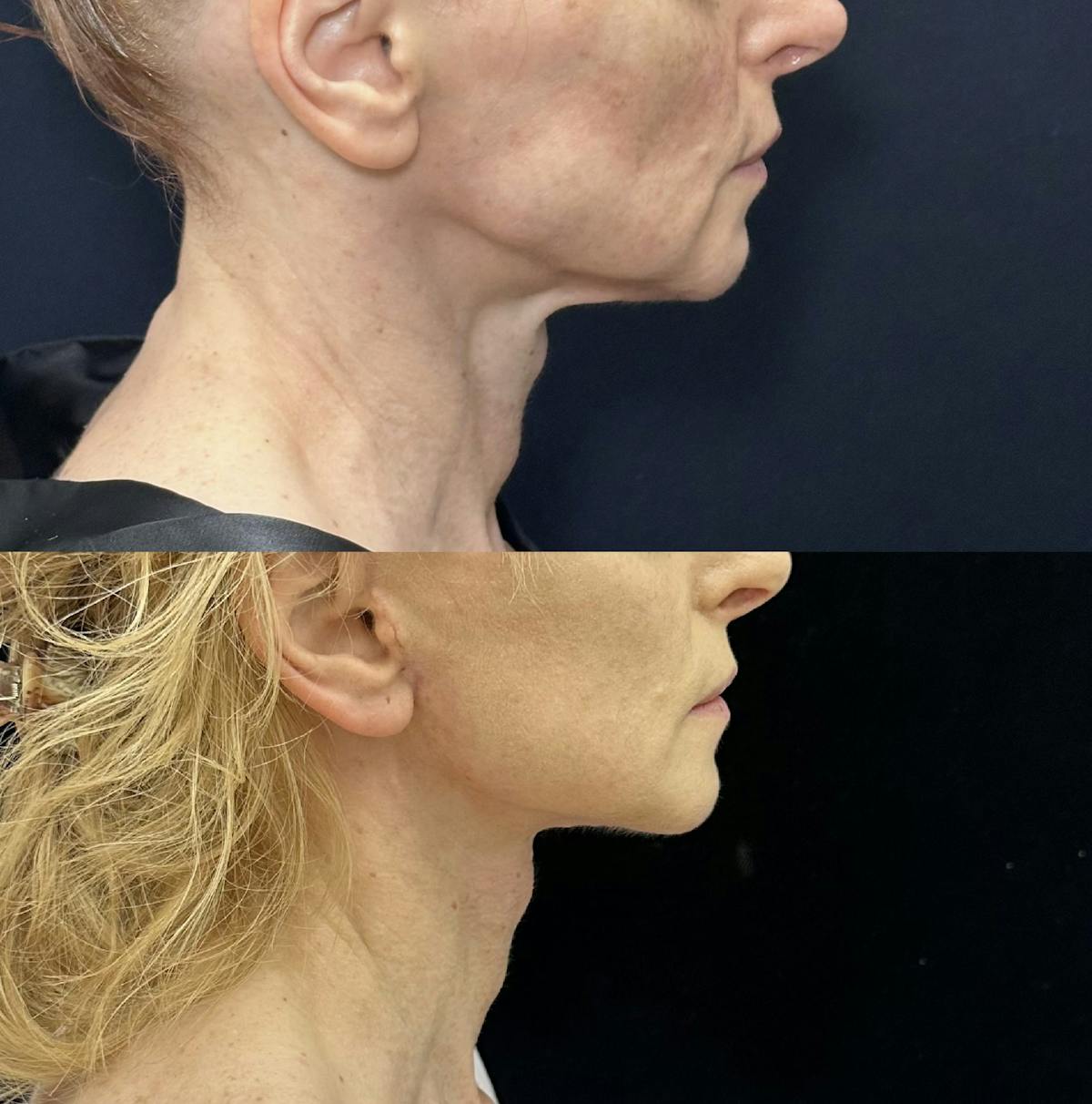 Deep Plane Facelift Before & After Gallery - Patient 635760 - Image 4