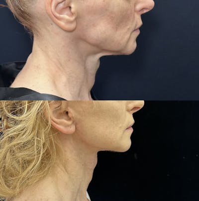 Deep Plane Facelift Before & After Gallery - Patient 635760 - Image 4