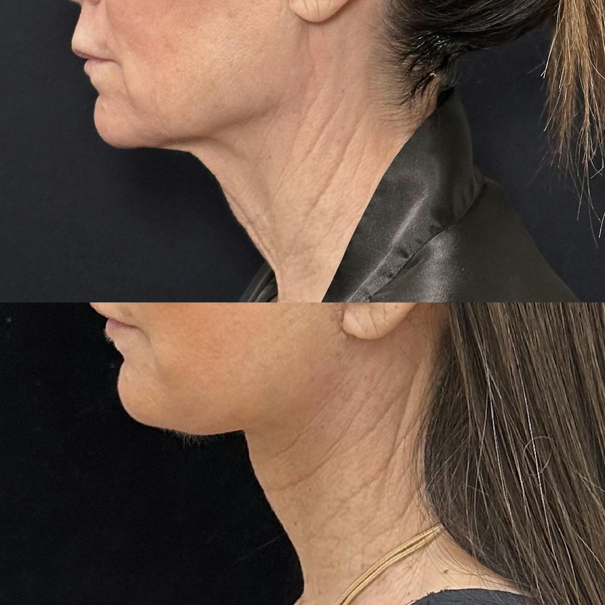 Deep Plane Facelift Before & After Gallery - Patient 226737 - Image 2