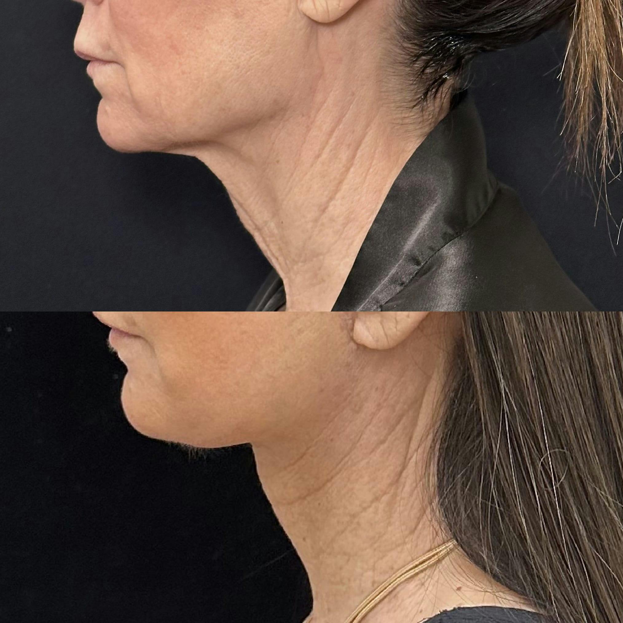 CO2 Laser Face Resurfacing Before & After Gallery - Patient 592194 - Image 2