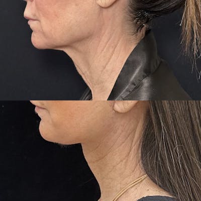 Deep Plane Facelift Before & After Gallery - Patient 226737 - Image 2