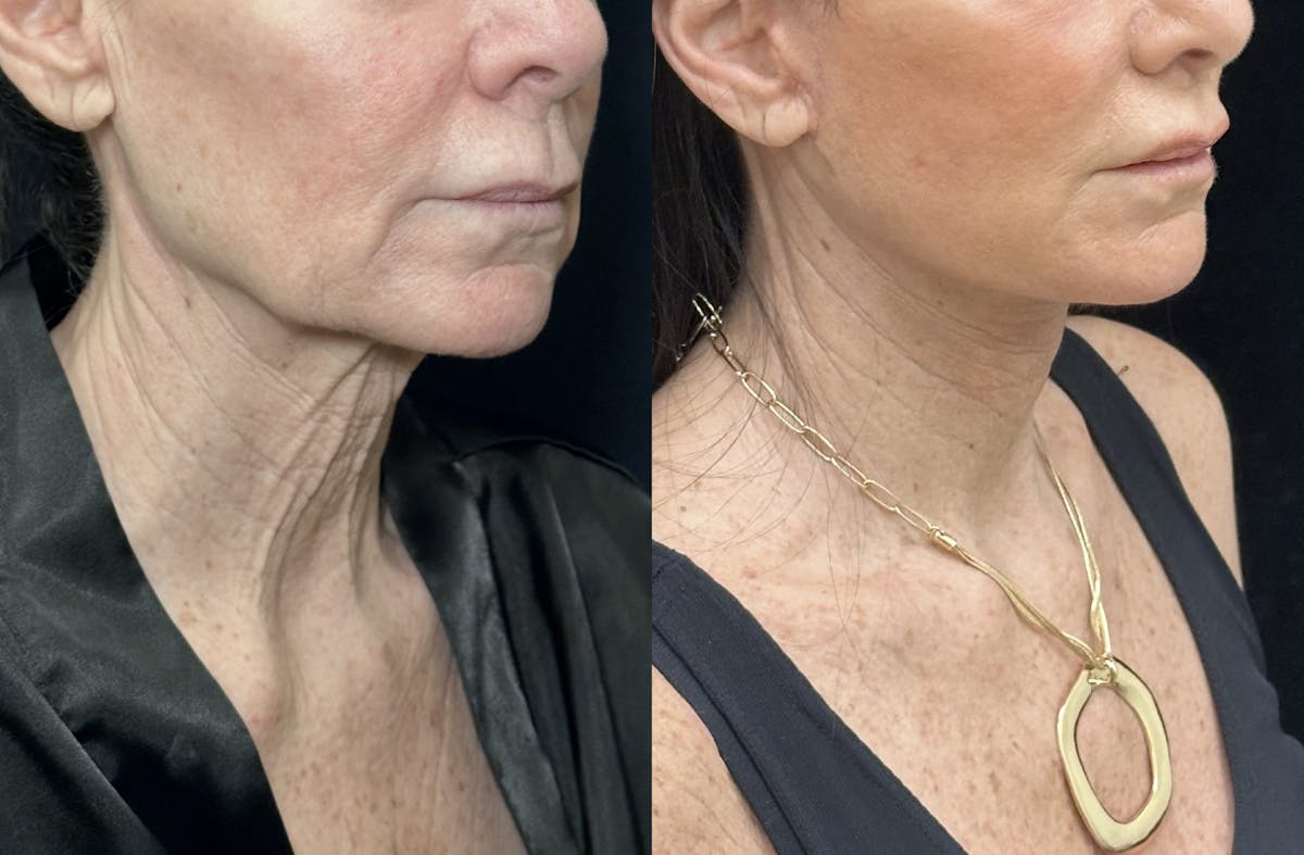 Deep Plane Facelift Before & After Gallery - Patient 226737 - Image 5