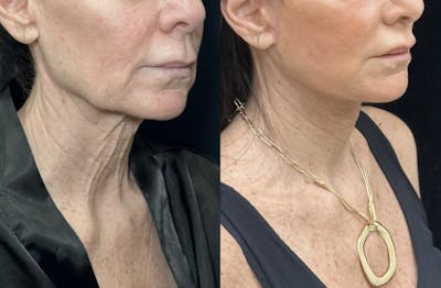 Deep Plane Facelift Before & After Gallery - Patient 226737 - Image 5