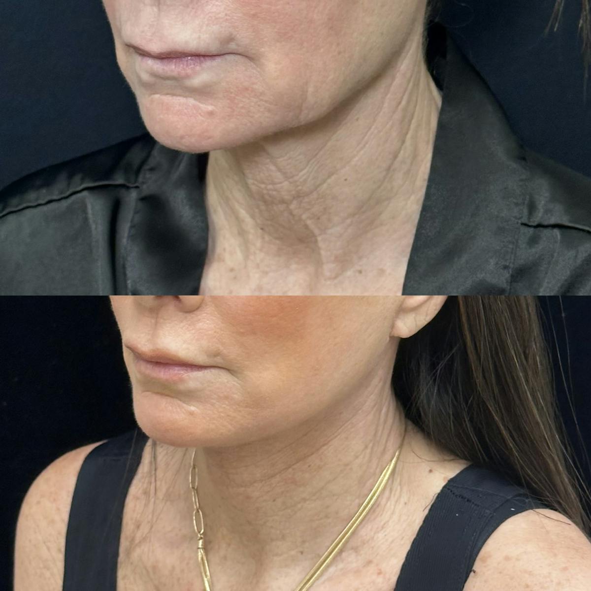 Deep Plane Facelift Before & After Gallery - Patient 226737 - Image 1