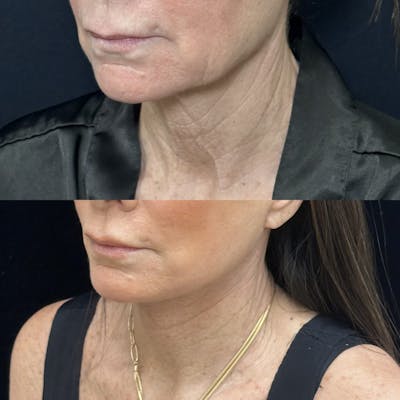 Deep Plane Facelift Before & After Gallery - Patient 226737 - Image 1