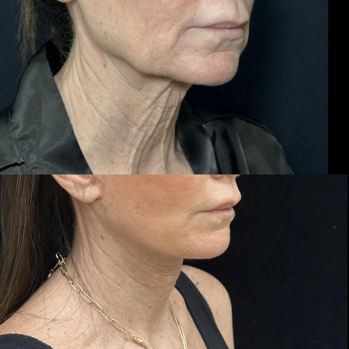 Deep Plane Facelift Before & After Gallery - Patient 226737 - Image 4
