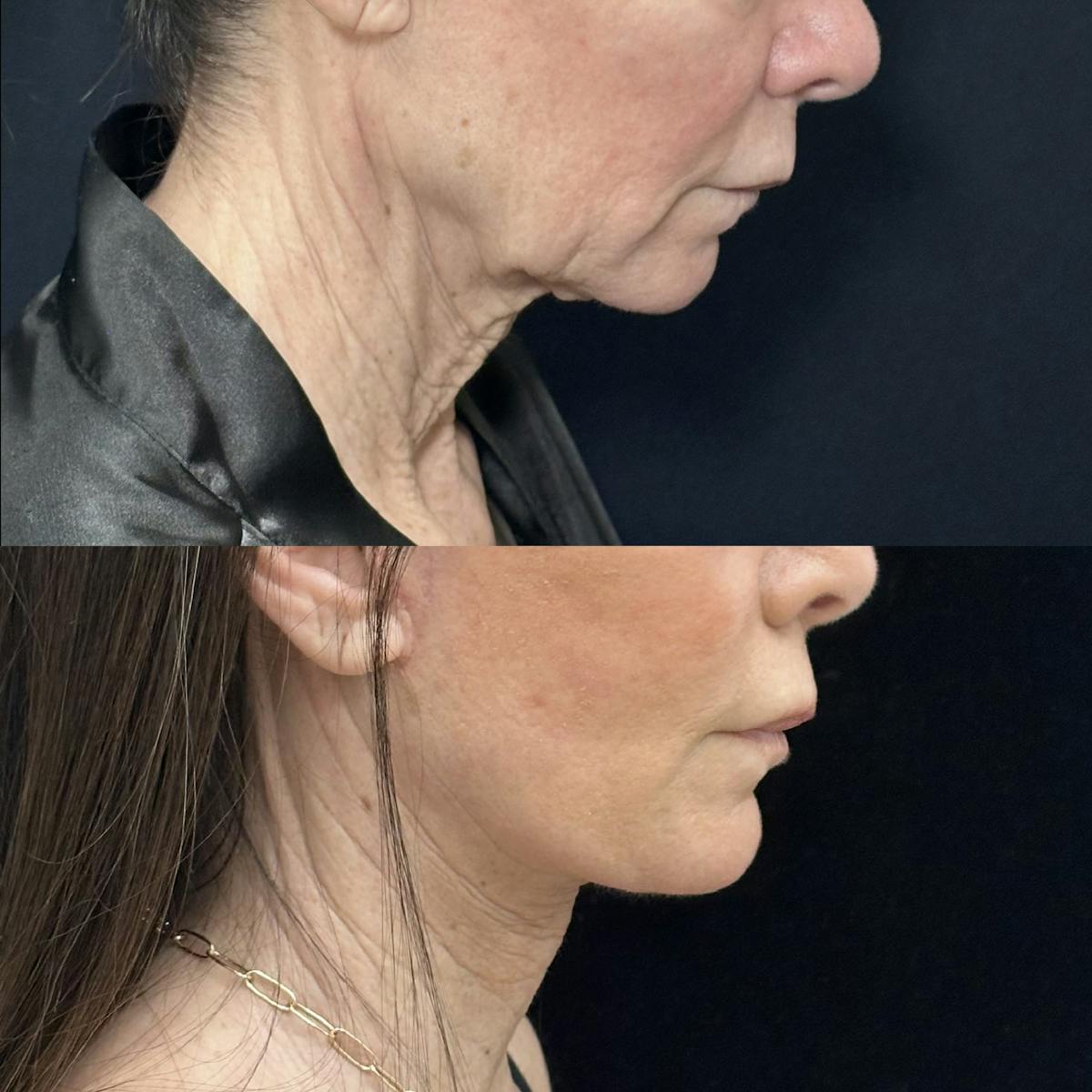 Deep Plane Facelift Before & After Gallery - Patient 226737 - Image 3