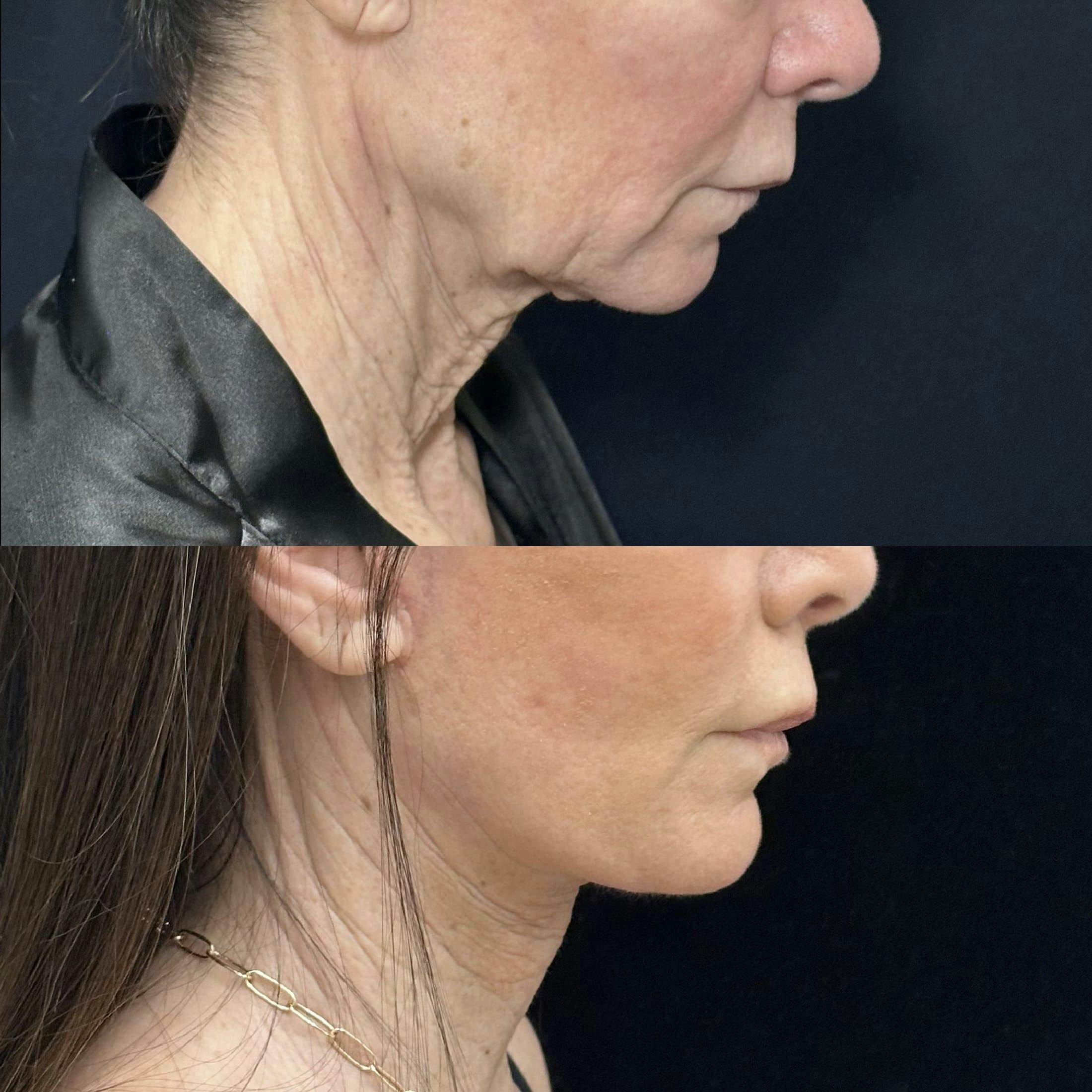CO2 Laser Face Resurfacing Before & After Gallery - Patient 592194 - Image 3