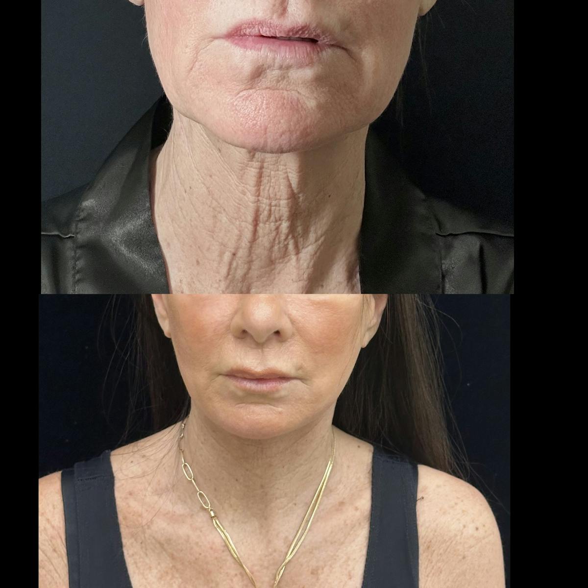 Deep Plane Facelift Before & After Gallery - Patient 226737 - Image 6