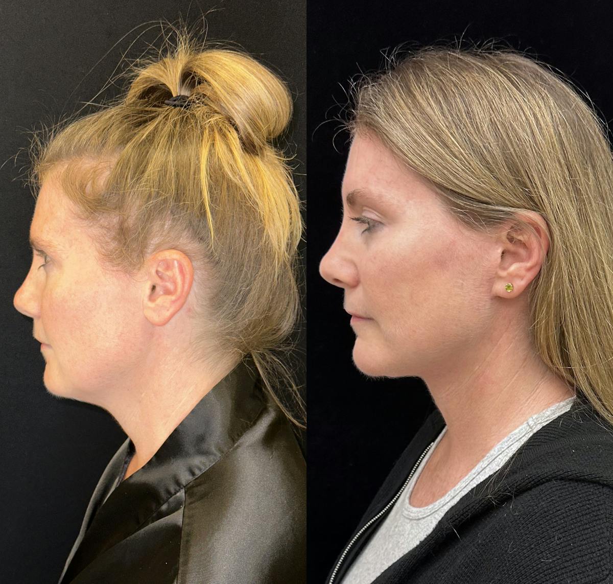 Deep Plane Facelift Before & After Gallery - Patient 157597 - Image 1