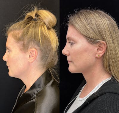 Deep Plane Facelift Before & After Gallery - Patient 157597 - Image 1