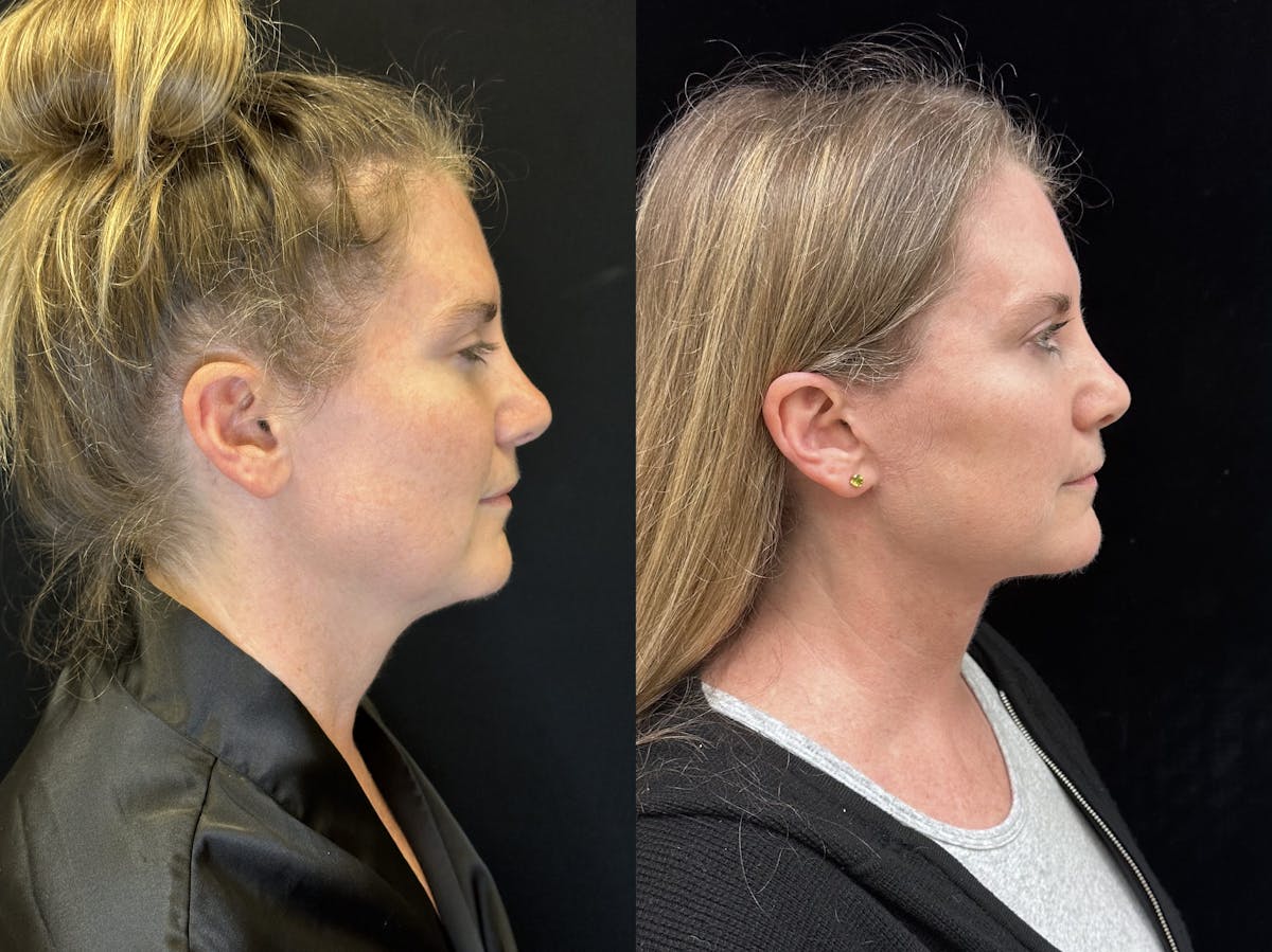 Deep Plane Facelift Before & After Gallery - Patient 157597 - Image 2