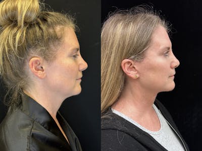 Deep Plane Facelift Before & After Gallery - Patient 157597 - Image 2