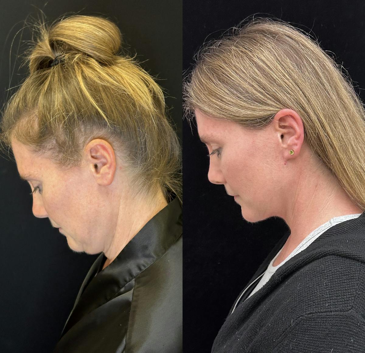 Deep Plane Facelift Before & After Gallery - Patient 157597 - Image 3