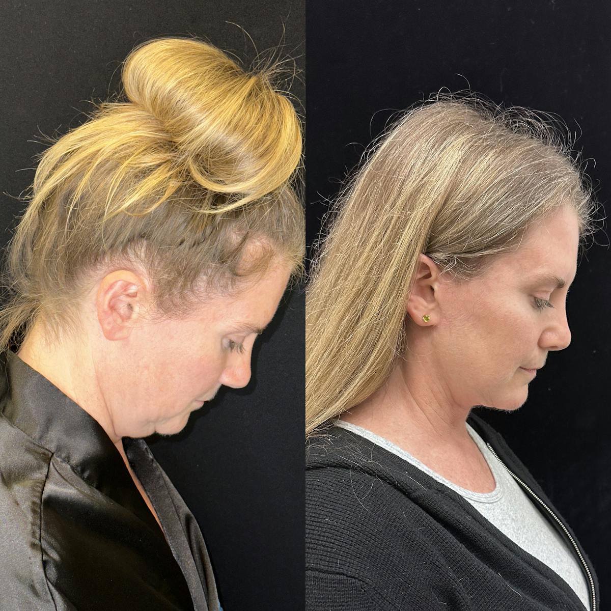 Deep Plane Facelift Before & After Gallery - Patient 157597 - Image 4