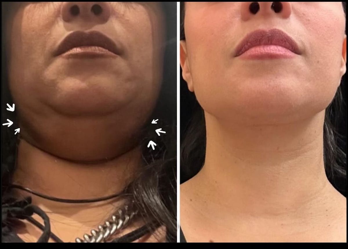 Necklift Before & After Gallery - Patient 288638 - Image 2